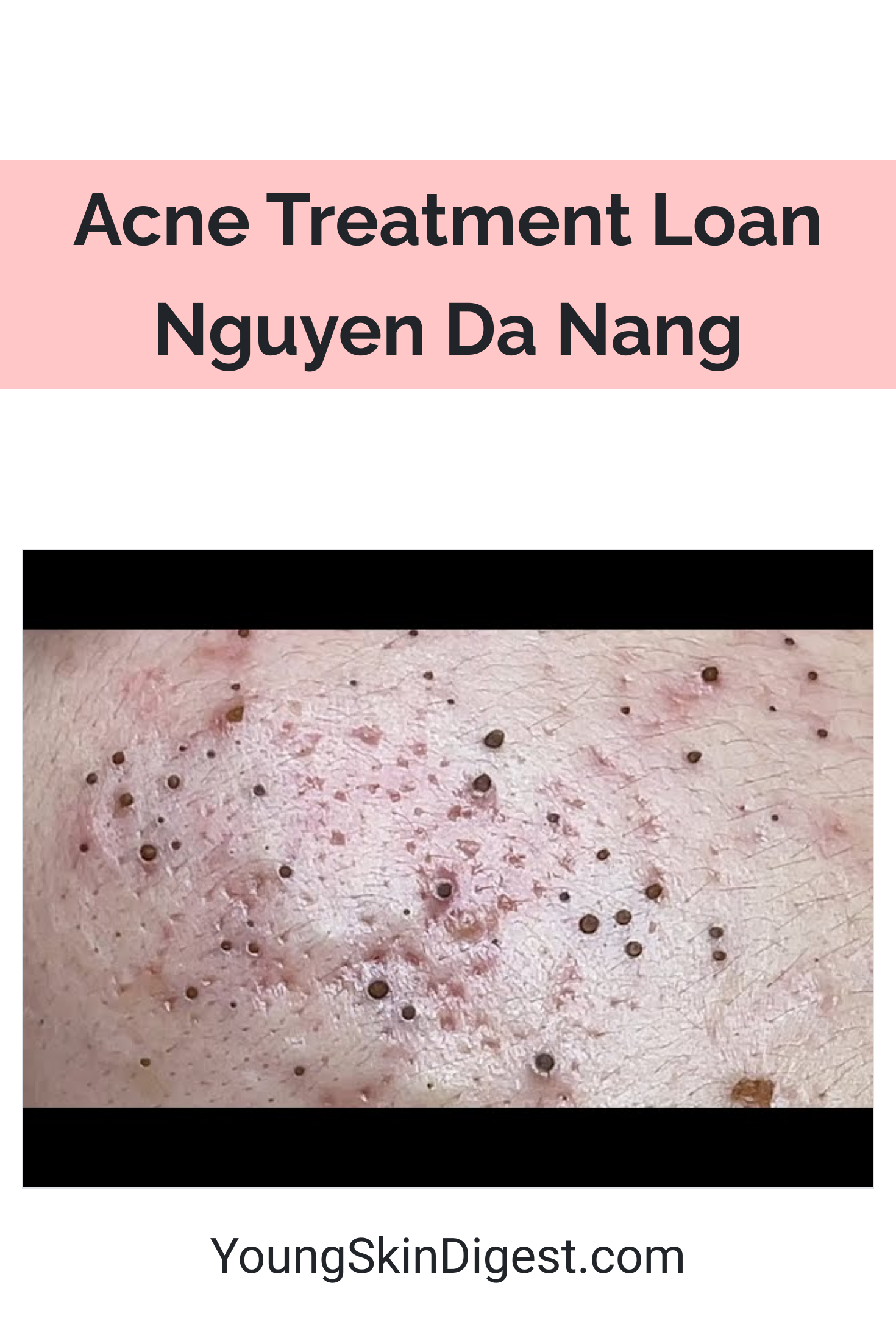 Acne Treatment Loan Nguyen Da Nang Young Skin Digest